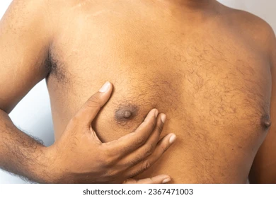 Gynécomastie Causes Symptômes Remède Naturel