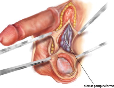 Varicocèle Testiculaire Causes Symptômes Traitement Naturel