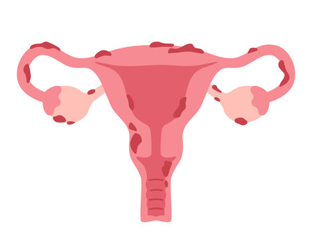 Endométriose Causes Conséquents Traitement Naturel de l'Endométriose