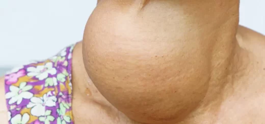 Goitre Nodulaire Causes Symptômes Traitement Naturel du Goitre
