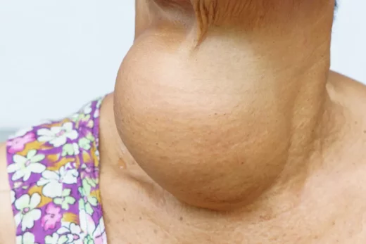 Goitre Nodulaire Causes Symptômes Traitement Naturel du Goitre