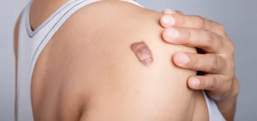 Chéloïdes Causes Symptômes Soin Naturelle contre les Chéloïdes