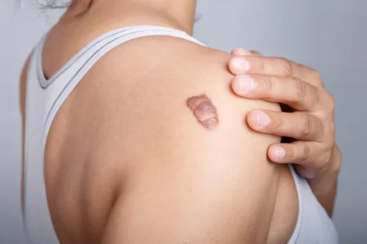 Chéloïdes Causes Symptômes Soin Naturelle contre les Chéloïdes