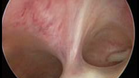 Synéchie Utérine Causes Symptômes Recette Naturelle contre Synéchie Utérine