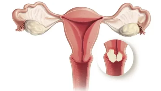 Cancer du Col de l’Utérus Causes Symptômes Prévention Traitement Naturel Sûr