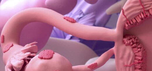 Endométriose Causes Symptômes Traitement Naturel Sûr de l' Endométriose