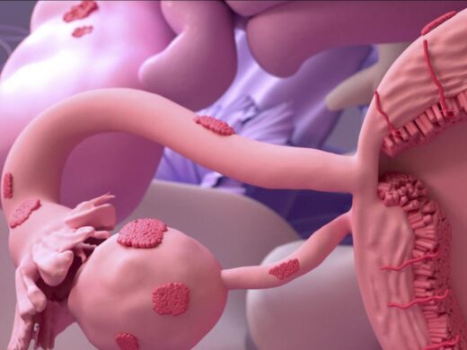 Endométriose Causes Symptômes Traitement Naturel Sûr de l' Endométriose