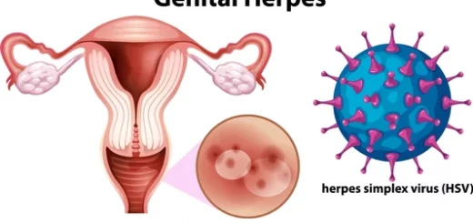 Herpès Génital Causes Symptômes Prévention Solution naturelle
