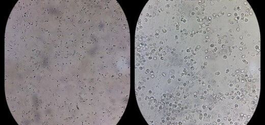 Azoospermie Causes Symptômes Traitement Naturel Sûr de l'infertilité Masculine