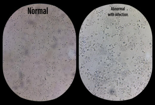 Azoospermie Causes Symptômes Traitement Naturel Sûr de l'infertilité Masculine