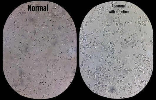 Azoospermie Causes Symptômes Traitement Naturel Sûr de l'infertilité Masculine