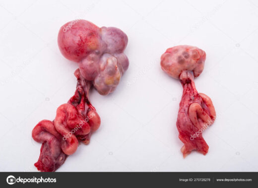 Comment Soigner Naturellement un Kyste Testiculaire ?