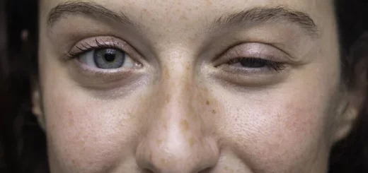Myasthénie Causes Symptômes Traitement Naturel de la Myasthénie