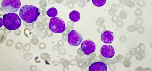 Leucémie Causes Symptômes Traitement Naturel Sûr Contre le Cancer du Sang