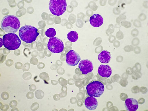 Leucémie Causes Symptômes Traitement Naturel Sûr Contre le Cancer du Sang