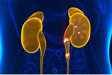 Microlithiase Rénale Causes Symptômes Traitement Naturel de Microlithiase Urinaire