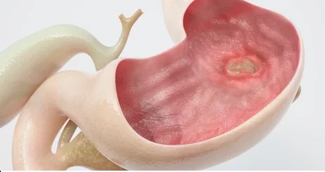 Ulcère Gastrique Causes Symptômes Traitement Naturel de l' Ulcère Gastrique