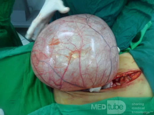 Meilleur Traitement pour Guérir Naturellement d'un Kyste Ovarien