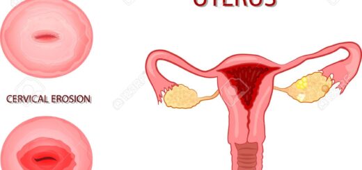 Cervicite Causes Symptômes Prévention Traitement Naturel de la Cervicite