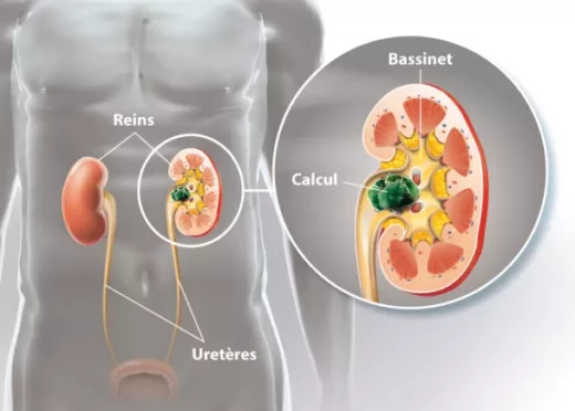 Comment Soigner Naturellement une Lithiase Rénale ?
