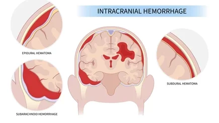 Hémorragie Cérébrale Causes Symptômes Prévention Traitement Naturel