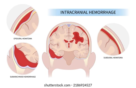 Hémorragie Cérébrale Causes Symptômes Prévention Traitement Naturel