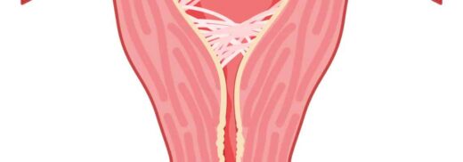 Comment Traiter Naturellement une Synéchie Uterine ?