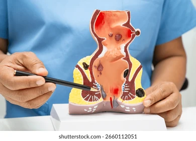 Comment Traiter Naturellement les Hémorroïdes en peu de Temps ?