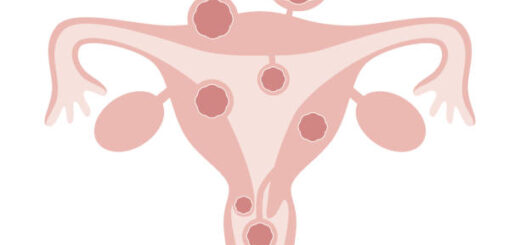 Comment Traiter Naturellement un Utérus Polymyomateux ?