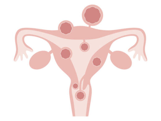 Comment Traiter Naturellement un Utérus Polymyomateux ?