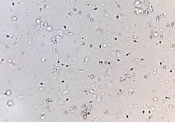 Comment Traiter Naturellement une Azoospermie Sévère ?