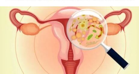 Phimosis Tubaire Bilatéral Causes Symptômes Traitement Naturel