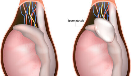 Comment Traiter Naturellement une Spermatocèle en peu de Temps ?