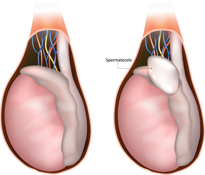 Comment Traiter Naturellement une Spermatocèle en peu de Temps ?