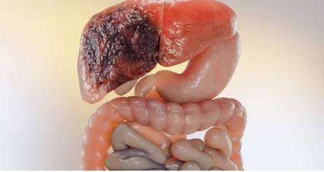 Comment Traiter Naturellement le Cancer du Foie en peu de Temps ?