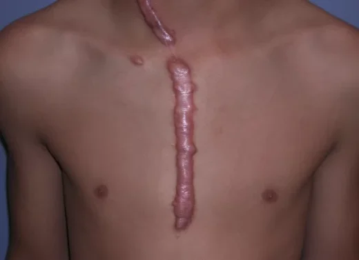 Comment Assécher Naturellement une Chéloïde en peu de Temps ?