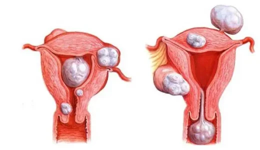 Comment Traiter Naturellement un Fibrome Utérin en peu de Temps ?