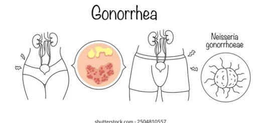 Comment Soigner Naturellement la Gonorrhée Par les Plantes Médicinales ?