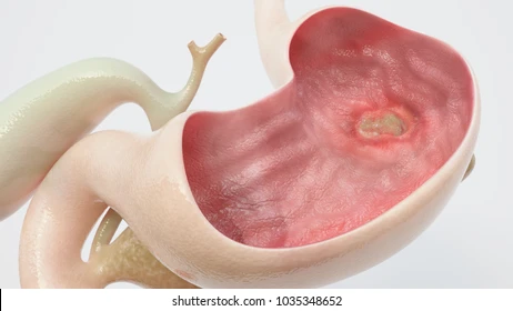 Comment Traiter Naturellement L'Ulcère Gastrique en peu de Temps ?