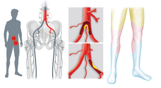 Artériopathies Causes Symptômes Prevention Traitement Naturel