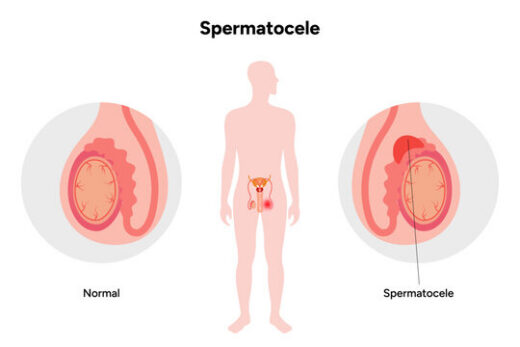 Comment Dissoudre Naturellement un Kyste Testiculaire en peu de Temps ?