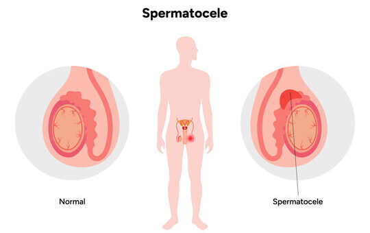 Comment Dissoudre Naturellement un Kyste Testiculaire en peu de Temps ?