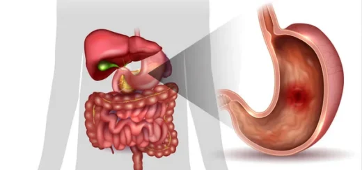 Comment Soigner Naturellement L’Ulcère Gastrique par les Plantes ?