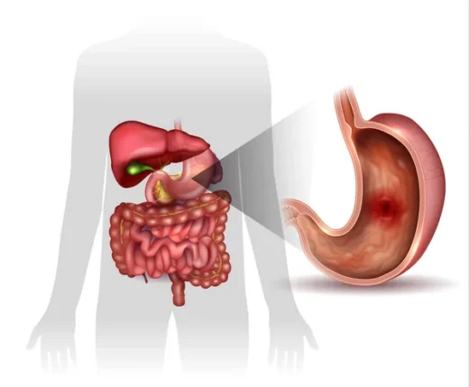 Comment Soigner Naturellement L’Ulcère Gastrique par les Plantes ?
