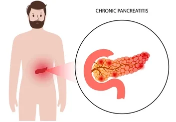Stéatose Pancréatique Causes Symptômes Traitement Naturel
