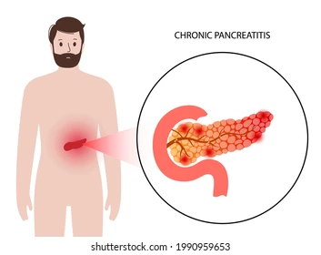 Stéatose Pancréatique Causes Symptômes Traitement Naturel