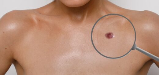 Dermatofibrome Causes Symptômes Traitement Naturel