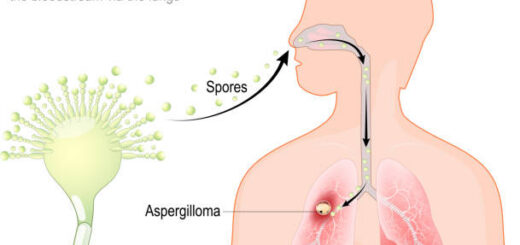 Comment Soigner Naturellement l' Aspergillose Par les Plantes Médicinales ?