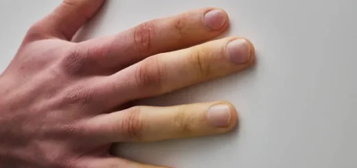 Sclérodermie Causes Symptômes Traitement Naturel