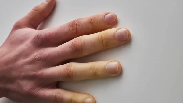 Sclérodermie Causes Symptômes Traitement Naturel